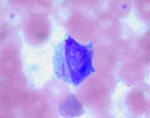Information on acute myeloid leukemia