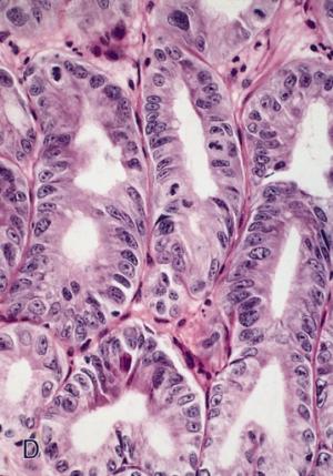 Information on Barrett's esophagus