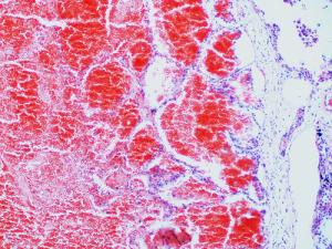Information on hemorrhagic stroke
