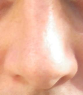Information on nosebleeds