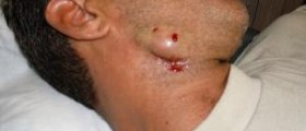 Ingrown hair causes and prevention