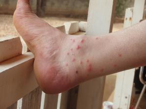 Insect bite rashes