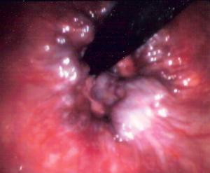 Internal hemorrhoids treatment