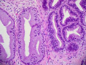 Invasive cancer of the cervix
