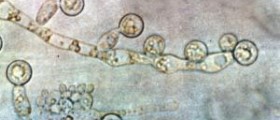 Is candida affecting your health ?