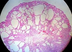 Is ectodermal dysplasia genetic disorder