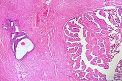 Is endometriosis dangerous