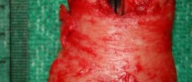 Is the prostate cancer biopsy an effective diagnostic tool?