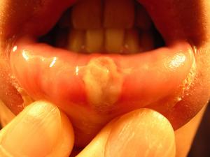 Is there a cure for canker sores?
