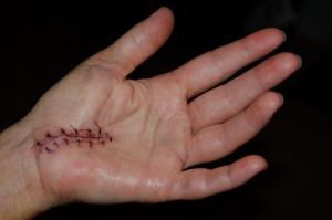 Is there a cure for carpal tunnel syndrome