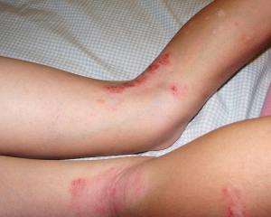 Is there a cure for dermatitis?