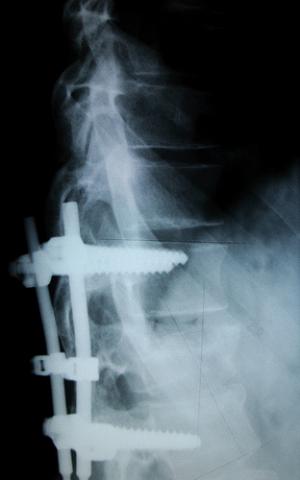 Is there a cure for Kyphosis