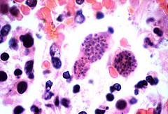 Is there a higher risk to your pregnancy because of toxoplasmosis?