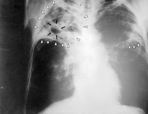 Is tuberculosis contagious?