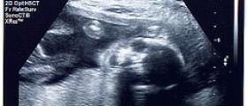 Is ultrasound safe during pregnancy?