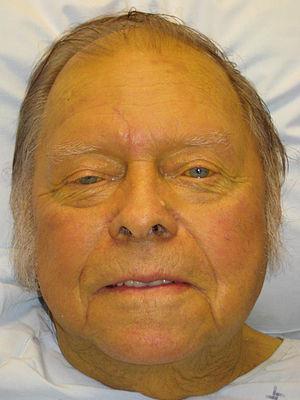 Jaundice in adults