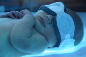 Jaundice in newborns