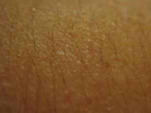 Keratosis pilaris on face