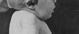 Klippel-Trenaunay syndrome in children