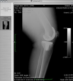 Knee replacement surgery complications