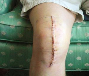 Knee surgery recovery time