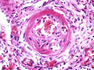 Labile hypertension facts