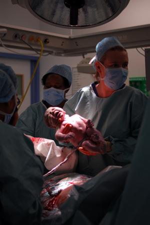 Labour complications