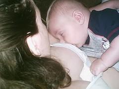 Lactational mastitis: Signs and symptoms