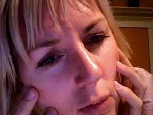 Laser surgery treatment for rosacea
