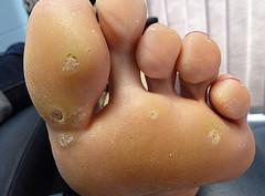 Laser therapy for warts