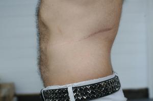 Laser treatment for scars