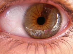 Lasik eye surgery in UK