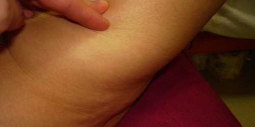 Cellulite: Plenty Of Treatments, No Cure