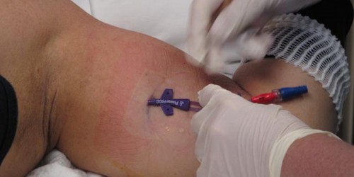 Interferon Treatment For Leukemia