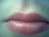 Lip augmentation for more beautiful lips