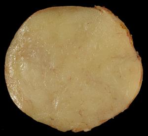 Lipoma treatment facts