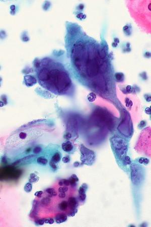 Living with herpes simplex