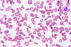 Low ferritin levels symptoms