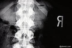 Lumbar puncture complications