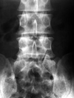 Lumbar spine MRI