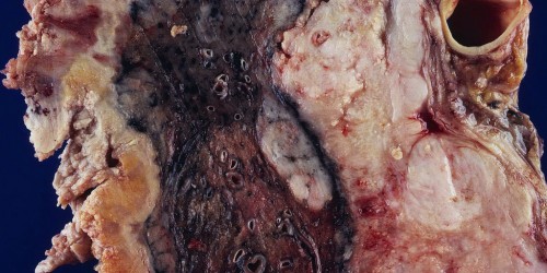 Coping When Newly Diagnosed With Mesothelioma