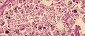 Lung cancer and mesothelioma