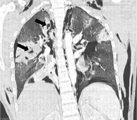 Lung diseases caused by smoking