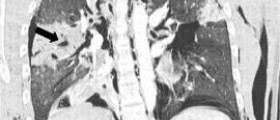 Lung diseases caused by smoking