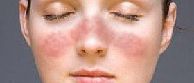 Lupus and eye disease