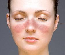Lupus disease prognosis