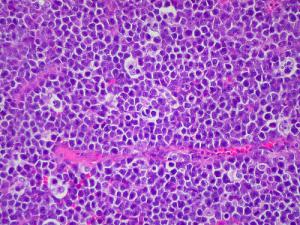 Lymphoma in children review