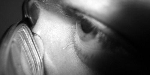 Ocular Albinism Symptoms and Treatment