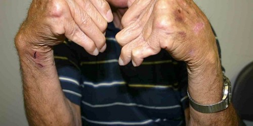 Arthritis And Platelet-Rich Plasma Treatment