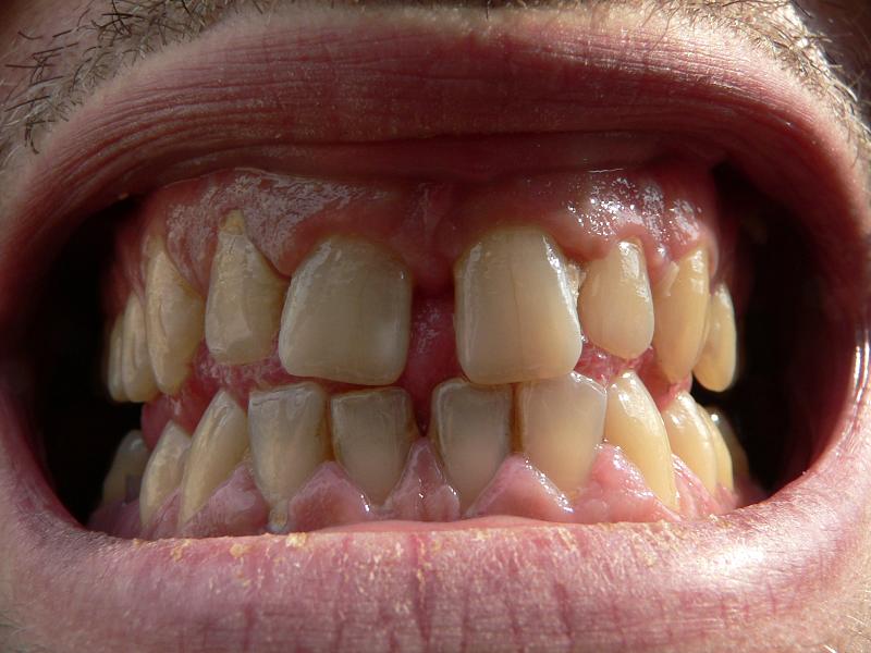 what can i do for a tooth infection at home